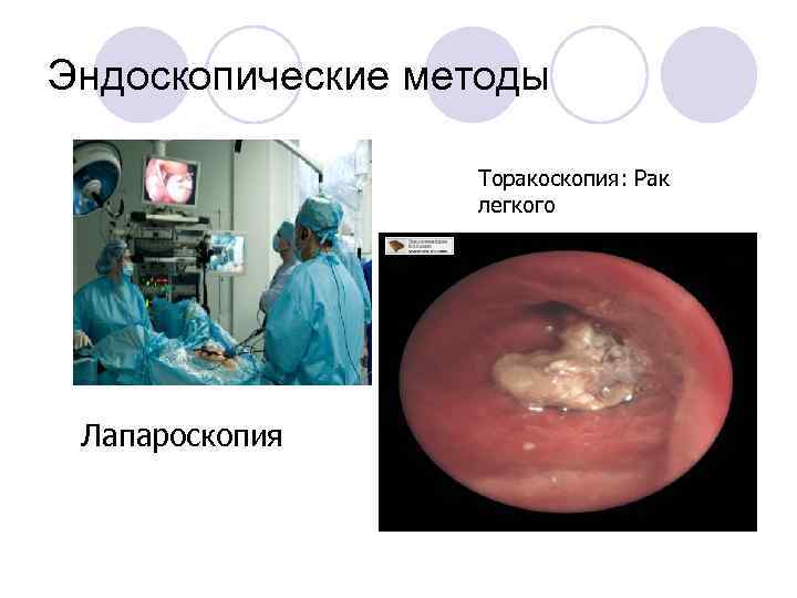 Эндоскопические методы Торакоскопия: Рак легкого Лапароскопия 
