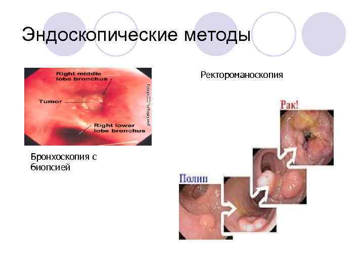 Эндоскопические методы Ректороманоскопия Бронхоскопия с биопсией 