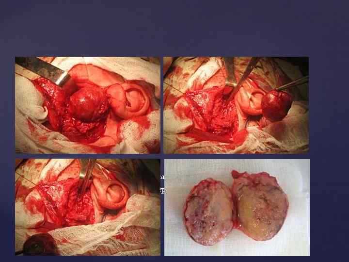 Удаление плеоморфной аденомы околоушной слюнной железы с сохранением ветвей лицевого нерва 