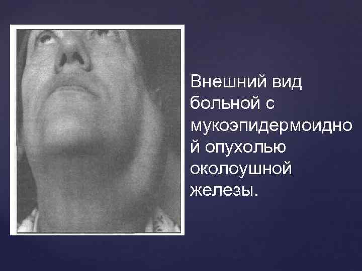 Внешний вид больной с мукоэпидермоидно й опухолью околоушной железы. 