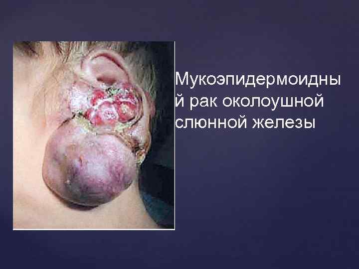 Мукоэпидермоидны й рак околоушной слюнной железы 