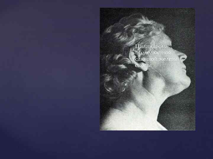 { Цилиндрома подчелюстной слюнной железы справа 