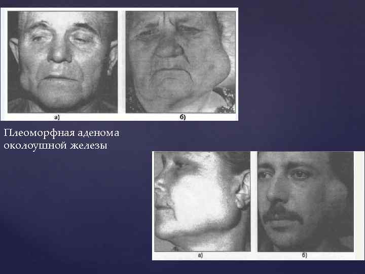 Плеоморфная аденома околоушной железы 