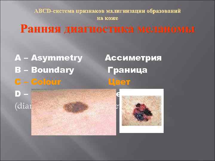  ABCD-система признаков малигнизации образований на коже Ранняя диагностика меланомы A – Asymmetry Ассиметрия