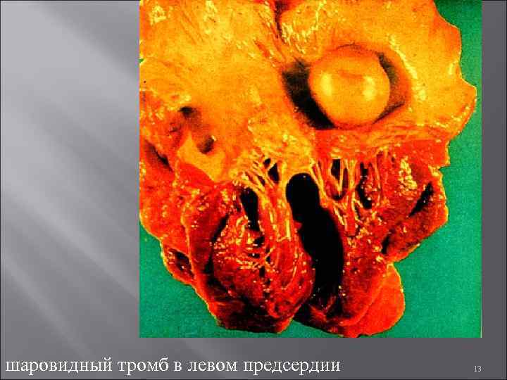 шаровидный тромб в левом предсердии 13 