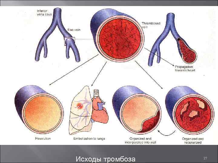 Исходы тромбоза 27 