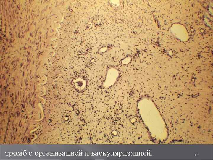 тромб с организацией и васкуляризацией. 31 