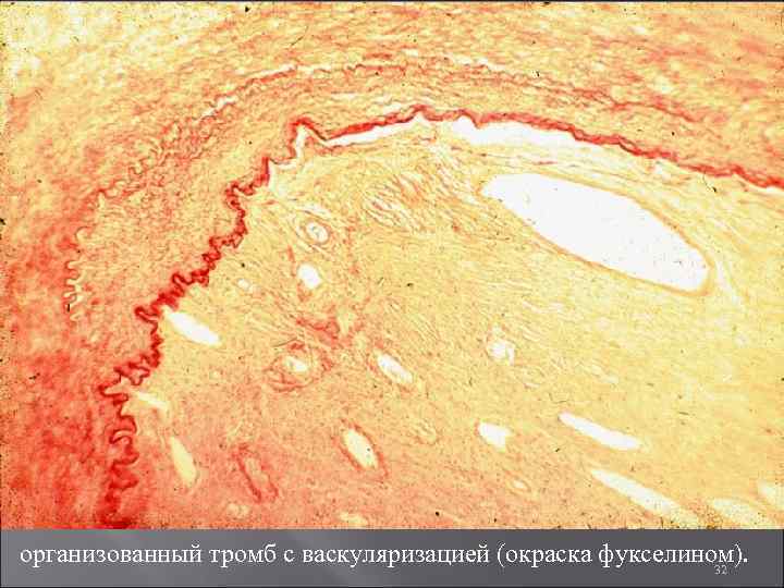 организованный тромб с васкуляризацией (окраска фукселином). 32 