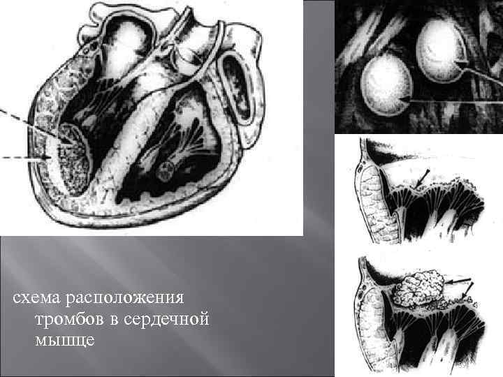 схема расположения тромбов в сердечной мышце 39 