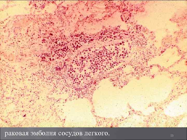 раковая эмболия сосудов легкого. 53 