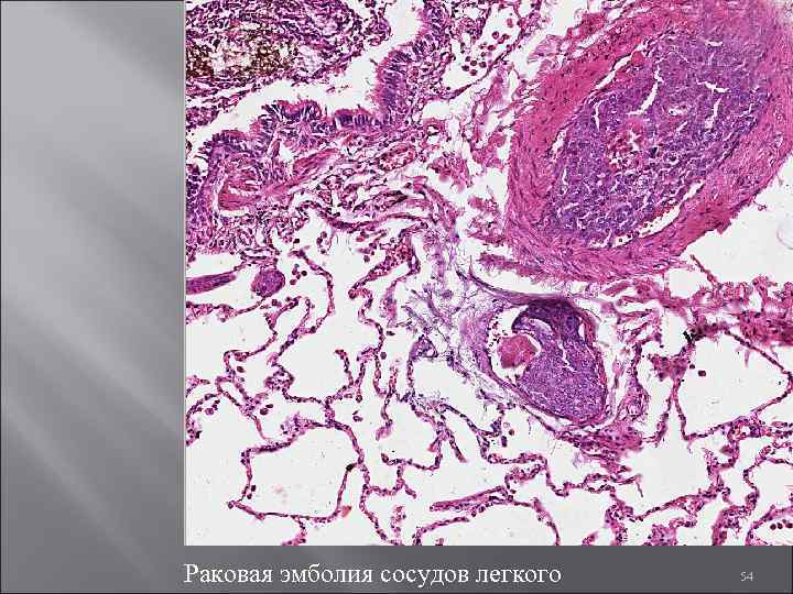 Раковая эмболия сосудов легкого 54 