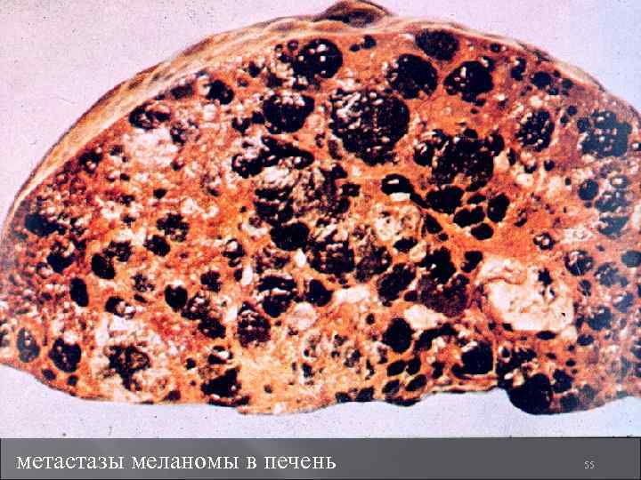 метастазы меланомы в печень 55 