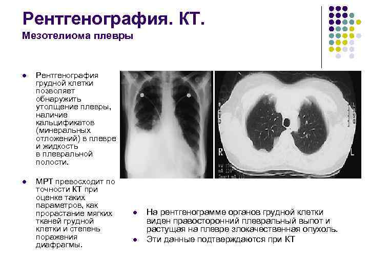 Мезотелиома плевры кт картина