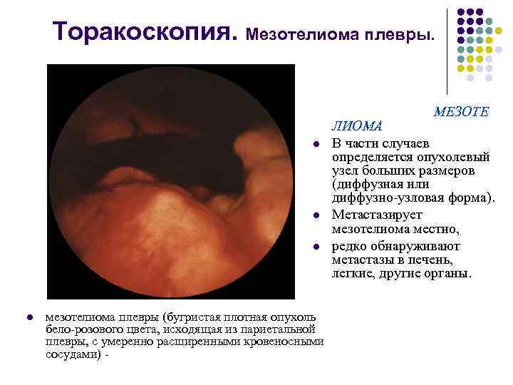  Торакоскопия. Мезотелиома плевры. МЕЗОТЕ ЛИОМА l В части случаев определяется опухолевый узел больших