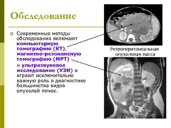 Обследование p  Современные методы обследования включают компьютерную томографию (КТ),   Ретроперитонеальная магнитно-резонансную