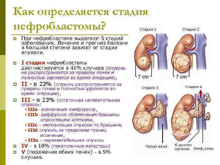 Как определяется стадия нефробластомы? p  При нефробластоме выделяют 5 стадий заболевания. Лечение и