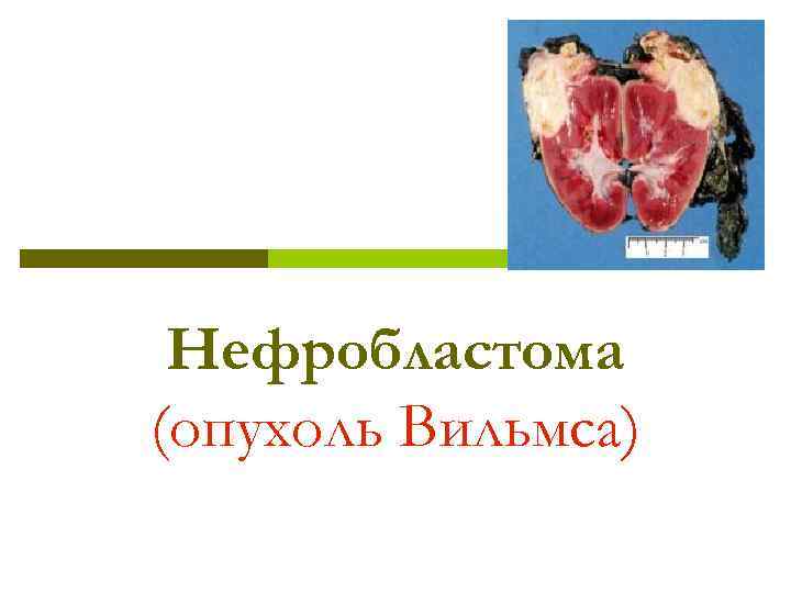  Нефробластома (опухоль Вильмса) 