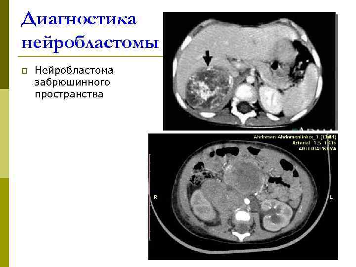 Диагностика нейробластомы p  Нейробластома забрюшинного пространства 