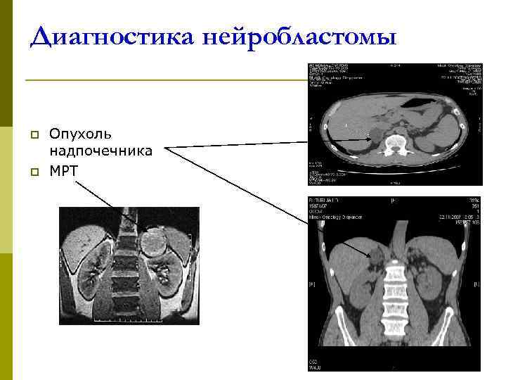 Диагностика нейробластомы  p  Опухоль надпочечника p  МРТ 