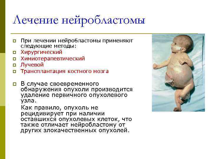 Лечение нейробластомы p  При лечении нейробластомы применяют следующие методы: p  Хирургический p