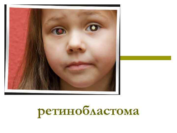 ретинобластома 