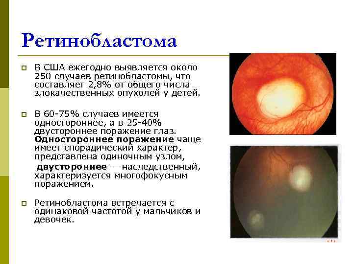 Ретинобластома p  В США ежегодно выявляется около 250 случаев ретинобластомы, что составляет 2,
