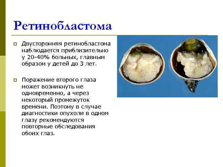 Ретинобластома p  Двусторонняя ретинобластома наблюдается приблизительно у 20 -40% больных, главным образом у