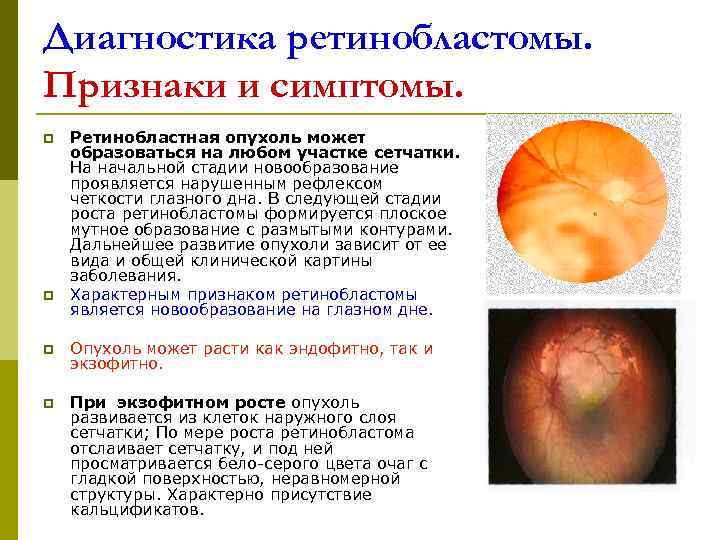Диагностика ретинобластомы. Признаки и симптомы. p  Ретинобластная опухоль может образоваться на любом участке