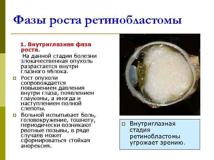 Фазы роста ретинобластомы 1. Внутриглазная фаза роста.   На данной стадии болезни злокачественная
