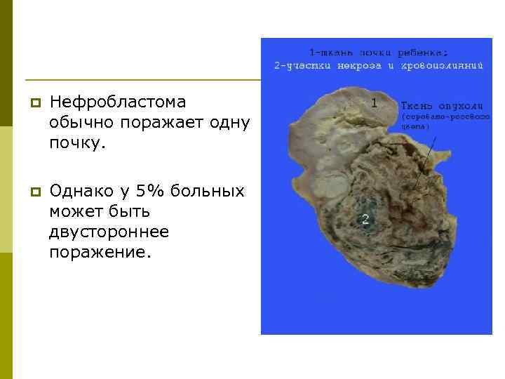 p  Нефробластома обычно поражает одну почку.  p  Однако у 5% больных