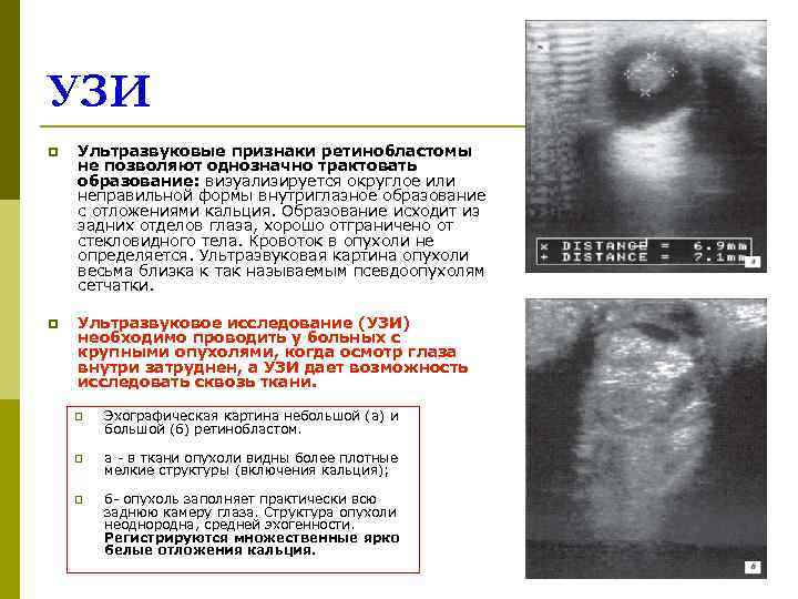 УЗИ p  Ультразвуковые признаки ретинобластомы не позволяют однозначно трактовать образование: визуализируется округлое или