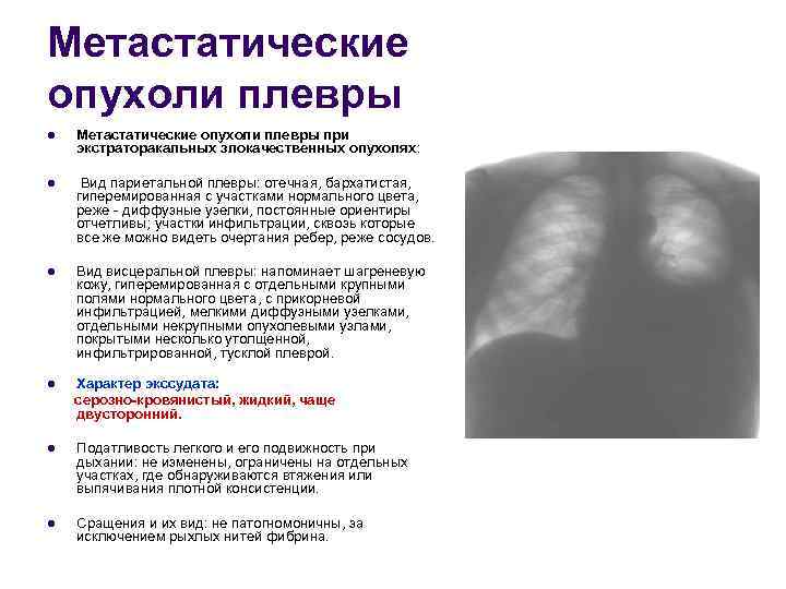 Метастатические опухоли плевры l  Метастатические опухоли плевры при экстраторакальных злокачественных опухолях:  l