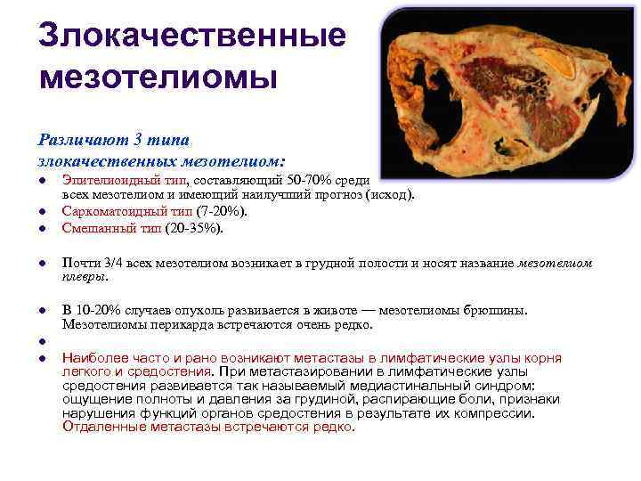 Злокачественные мезотелиомы Различают 3 типа злокачественных мезотелиом: l  Эпителиоидный тип, составляющий 50 -70%