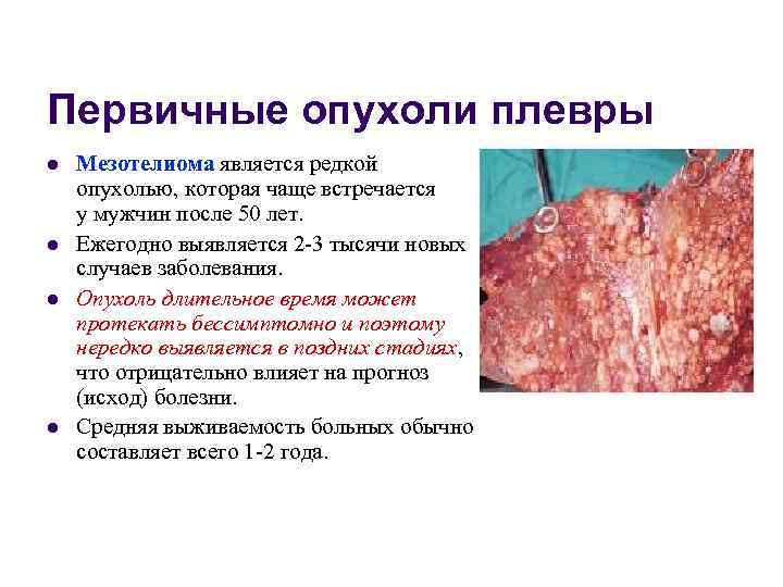 Первичные опухоли плевры l  Мезотелиома является редкой опухолью, которая чаще встречается у мужчин