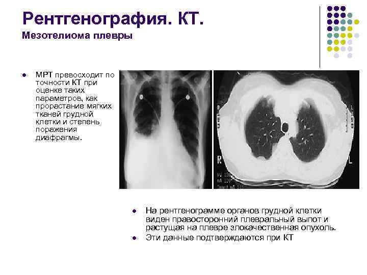 Мезотелиома плевры кт картина