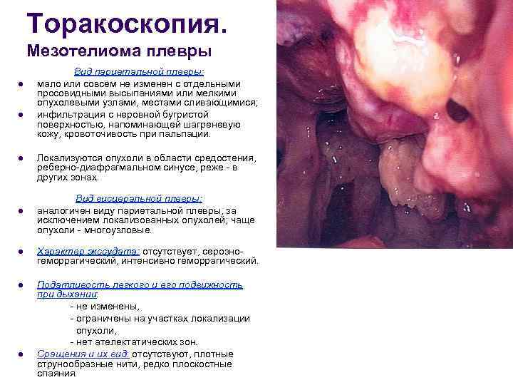   Торакоскопия. Мезотелиома плевры   Вид париетальной плевры:  l  мало