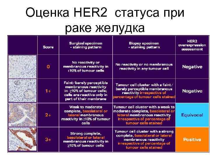 Оценка HER 2 статуса при раке желудка 