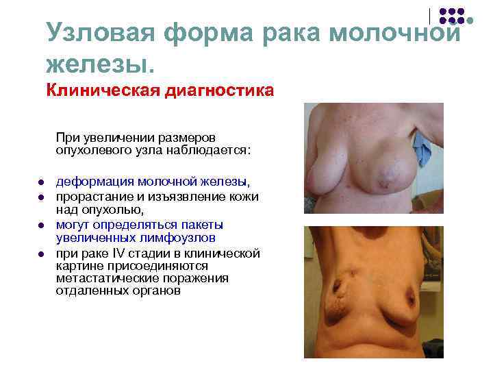 Узловая форма рака молочной железы. Клиническая диагностика При увеличении размеров Узловая форма рака молочной железы. Клиническая диагностика При увеличении размеров
