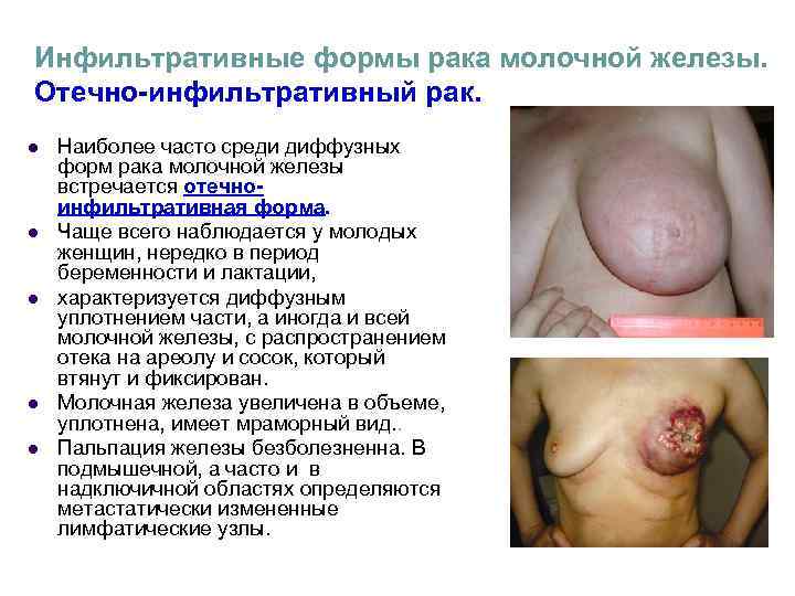 Инфильтративные формы рака молочной железы. Отечно-инфильтративный рак. l Наиболее часто среди диффузных Инфильтративные формы рака молочной железы. Отечно-инфильтративный рак. l Наиболее часто среди диффузных