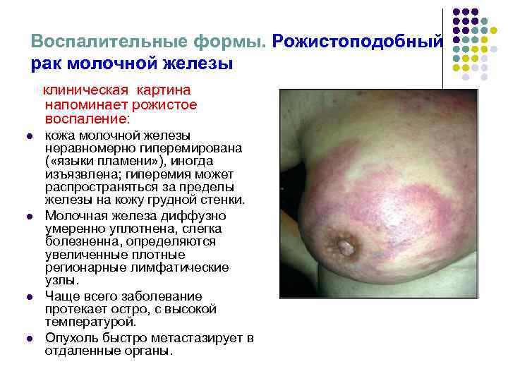 Воспалительные формы. Рожистоподобный рак молочной железы клиническая картина напоминает рожистое воспаление: l Воспалительные формы. Рожистоподобный рак молочной железы клиническая картина напоминает рожистое воспаление: l