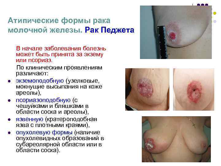 Атипические формы рака молочной железы. Рак Педжета В начале заболевания болезнь может Атипические формы рака молочной железы. Рак Педжета В начале заболевания болезнь может