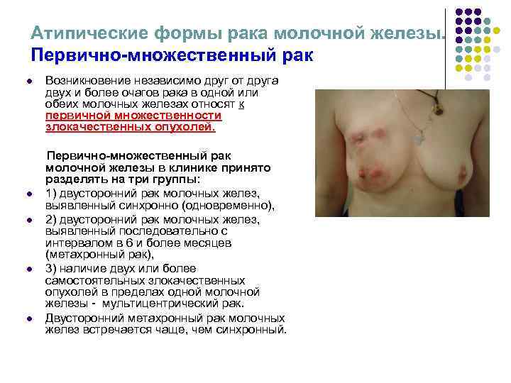 Атипические формы рака молочной железы. Первично-множественный рак l Возникновение независимо друг от Атипические формы рака молочной железы. Первично-множественный рак l Возникновение независимо друг от