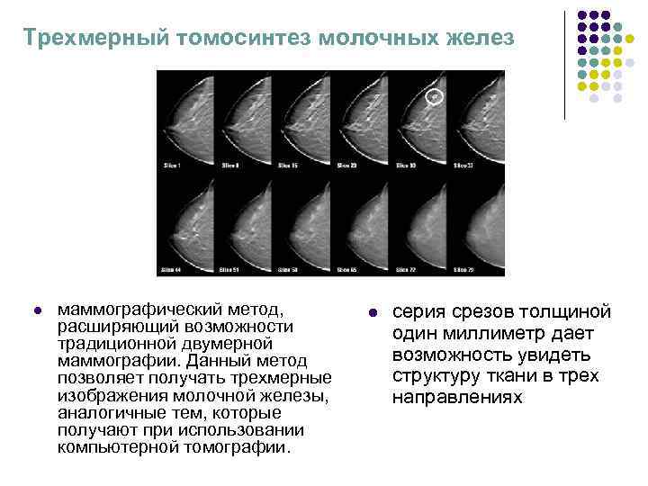 Томосинтез. Цифровой томосинтез молочных желез. Трехмерный томосинтез молочных желез. Ультразвуковой томосинтез молочных желез. Томосинтез молочных желез доза облучения.