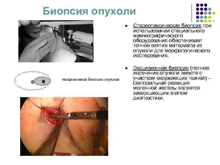 Биопсия опухоли l Стереотаксическая биопсия при Биопсия опухоли l Стереотаксическая биопсия при
