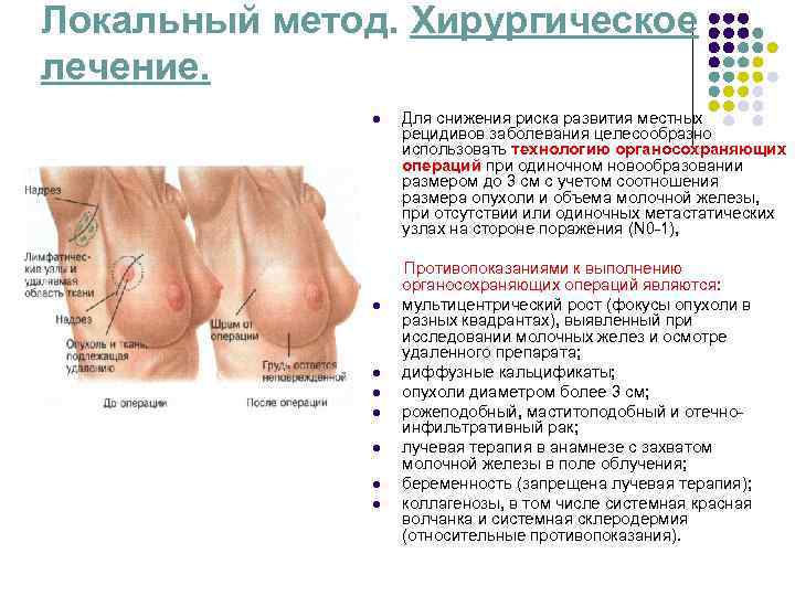 Локальный метод. Хирургическое лечение. l Для снижения риска развития местных Локальный метод. Хирургическое лечение. l Для снижения риска развития местных