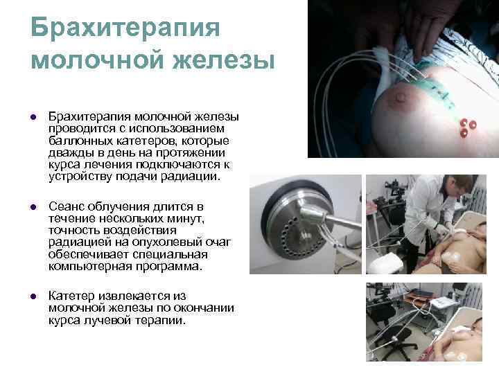 Брахитерапия молочной железы l Брахитерапия молочной железы проводится с использованием баллонных катетеров, которые Брахитерапия молочной железы l Брахитерапия молочной железы проводится с использованием баллонных катетеров, которые