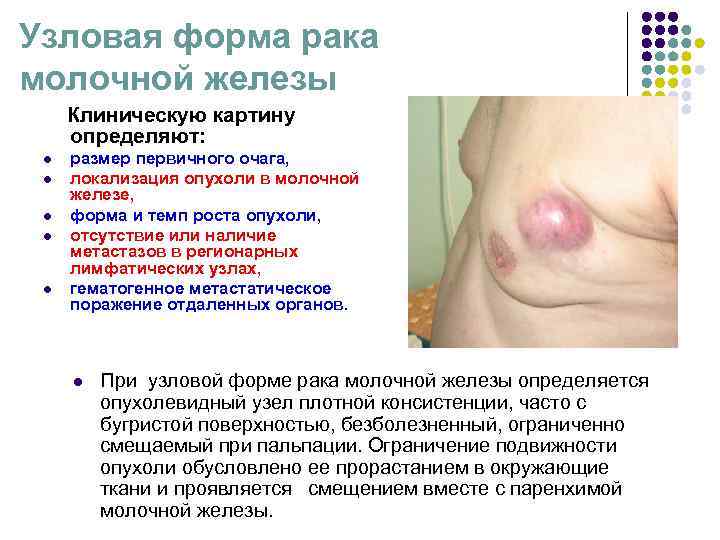 Узловая форма рака молочной железы Клиническую картину определяют: l размер первичного Узловая форма рака молочной железы Клиническую картину определяют: l размер первичного