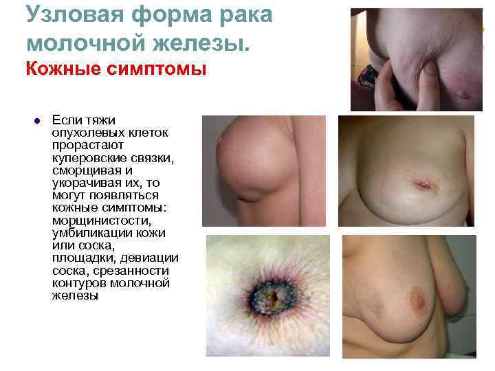 Узловая форма рака молочной железы. Кожные симптомы l Если тяжи опухолевых клеток Узловая форма рака молочной железы. Кожные симптомы l Если тяжи опухолевых клеток