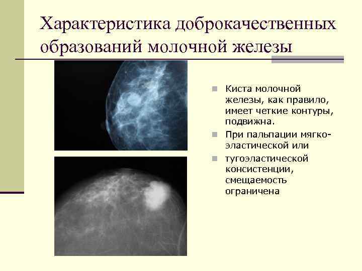 Доброкачественные опухоли форум. Фиброаденома молочной железы маммография. Доброкачественная опухоль молочной железы фиброаденома. Доброкачественные новообразования мол железы. Фиброаденома на УЗИ И маммографии.