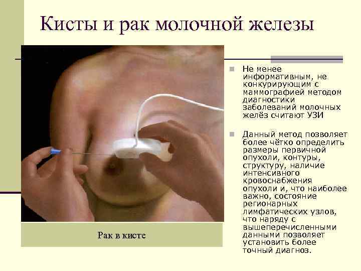 Кисты и рак молочной железы    n  Не менее  
